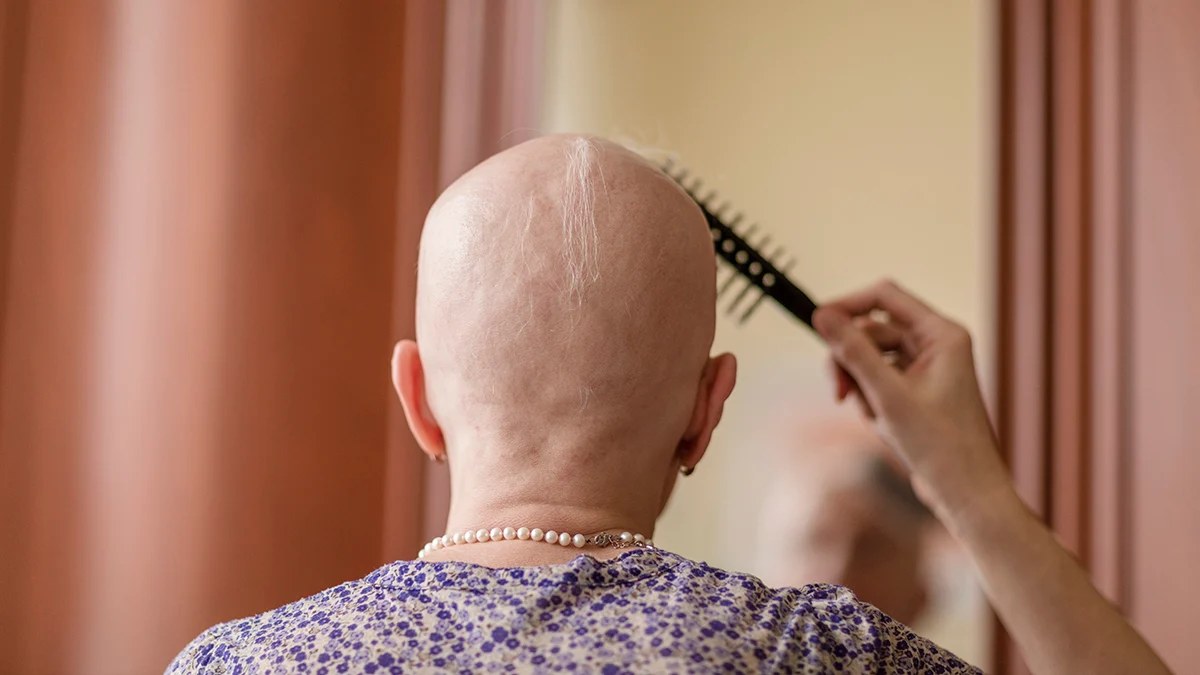 Yeni Bir İlaç, Şiddetli Alopesi Hastalarında Saç Döküşünü %100’e Kadar Geri Getirebilir