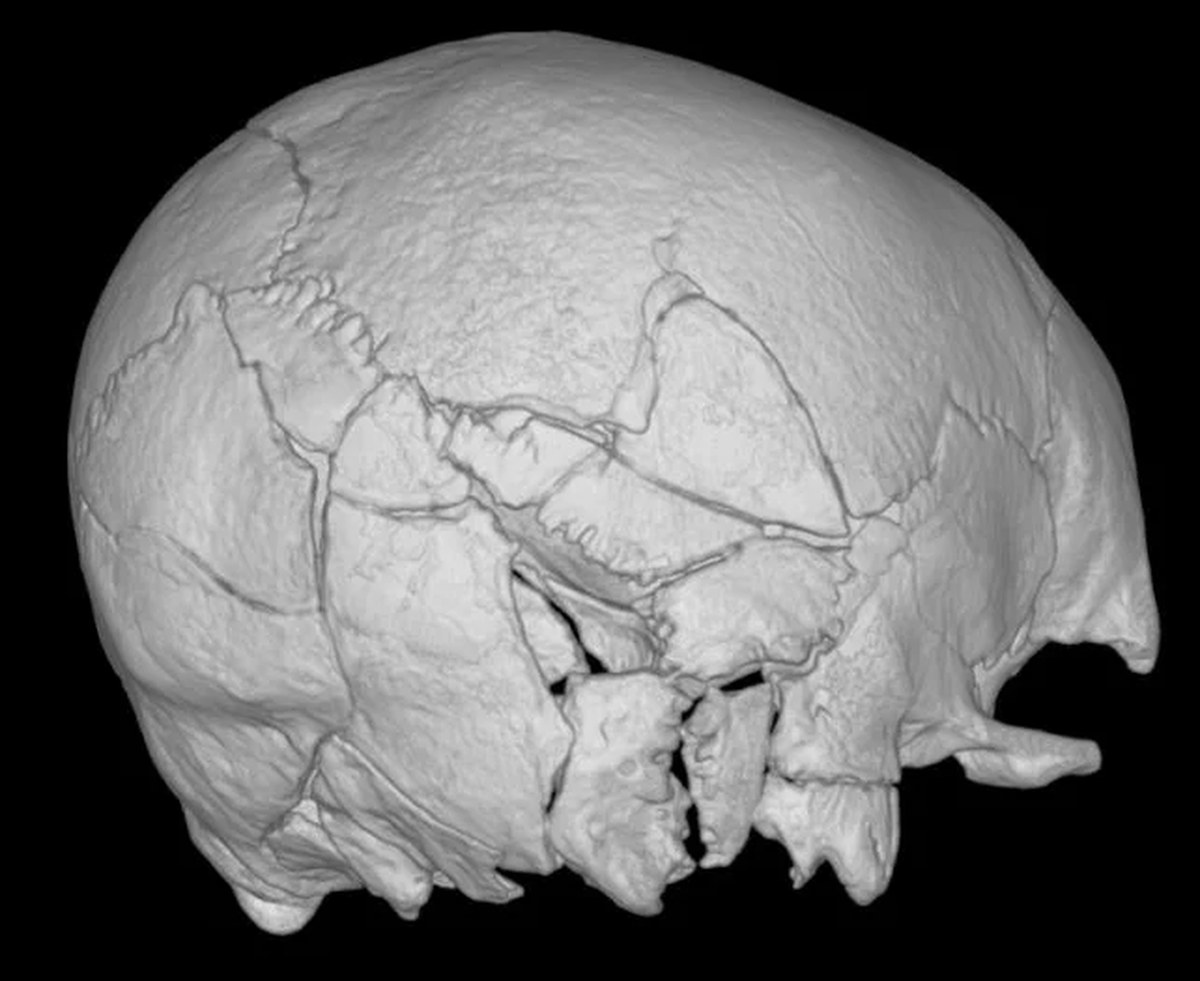 This Medieval Man Had Injuries Like He'd Been Hit by a Train. Scientists Suspect a Trebuchet.