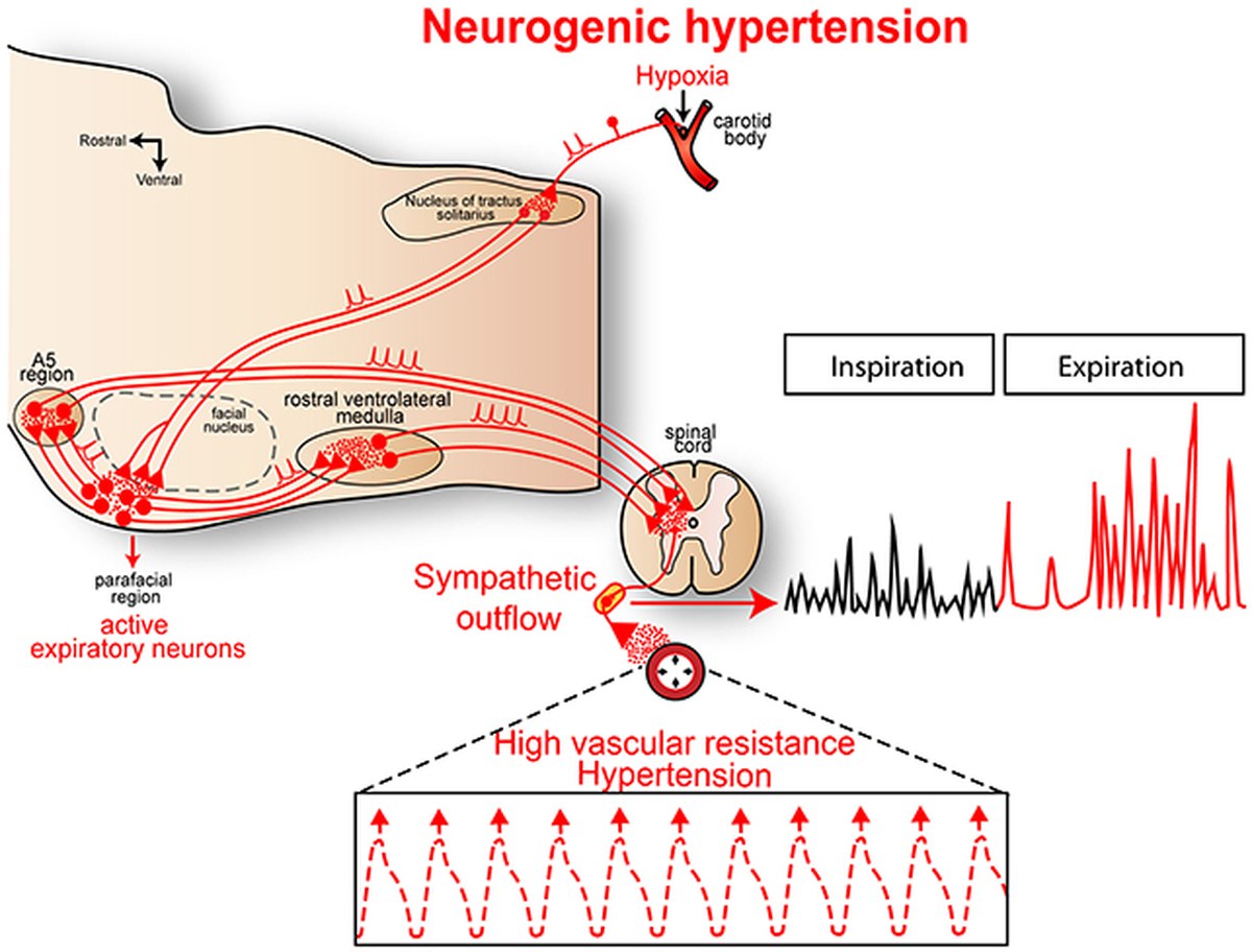 Hypertension diagram