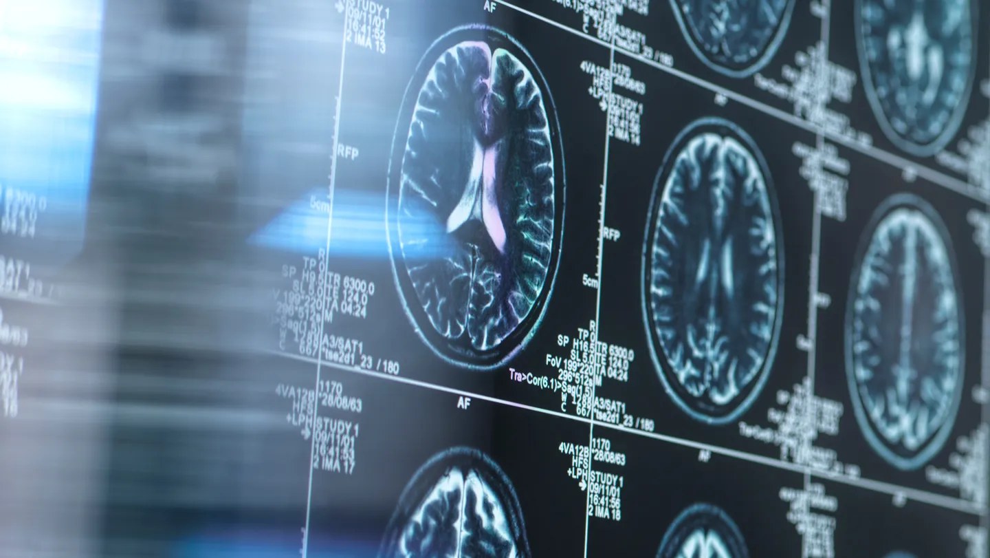 Manyetik Rezonans Görüntüleme, Alzheimer Hastalığı ile İlişkilendirilen Erken Beyin Değişikliklerini Ortaya Çıkarıyor